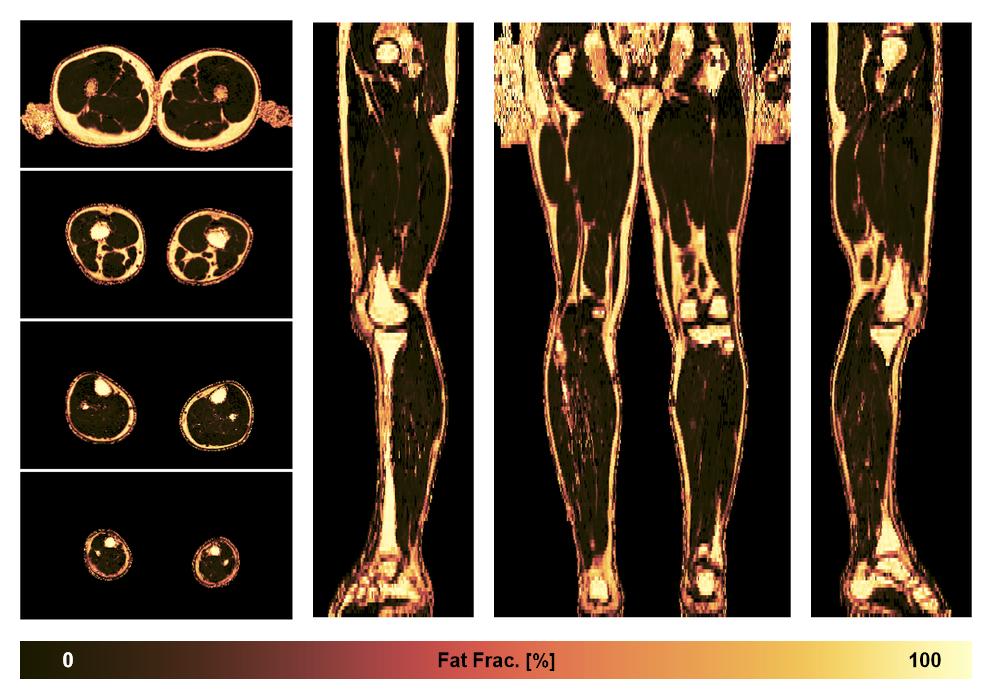 The fat fraction of the lower extremity obtained from the dixon reconstruction for muscle water fat quantification.